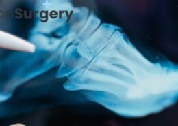 How does minimally invasive bunion surgery impact recovery time?