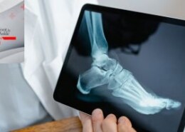Can I walk after bunion foot surgery? How long is the recovery time?