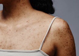 Body Acne Treatment in Dwarka – Advanced Solutions for Clear & Healthy Skin