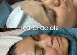 Are Azalea Med Spa's facial rejuvenation treatments suitable for all skin types?