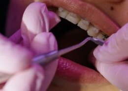 What should I know before getting braces treatment in Singapore?