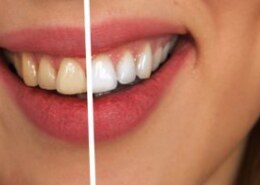 Are veneers in Tanjong Pagar a good option for improving my smile?