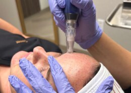 Who can I trust for microneedling at a med spa in Kansas City?