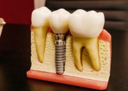 What should I know about tooth extractions, their cost, and whether Medisave can be used?