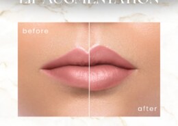 Why are lip fillers considered one of the most popular non-surgical cosmetic treatments today?