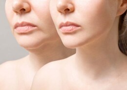 Lifting the Curtain: A Visual Guide to the Art of the Lip Lift