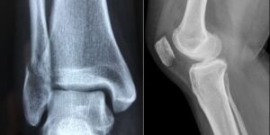 #cartilage repair singapore